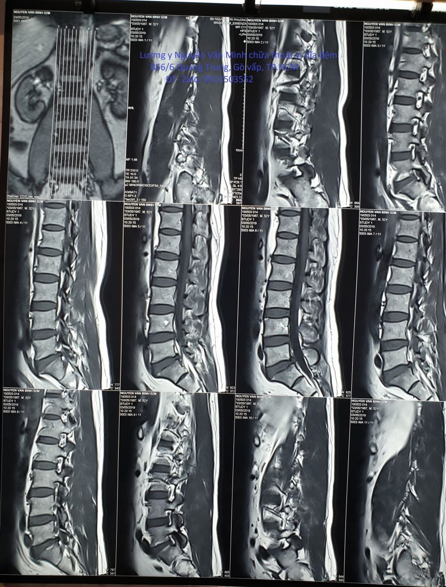 Chụp cộng hưởng từ cột sống thắt lưng